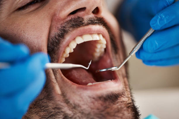 Best Emergency Tooth Extraction in Franklin, OH